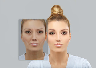 Effects of ageing,Frownscowl lines ,Nasolabial folds,Neck ,Under eye circles,neck lines. Plastic Surgery Results