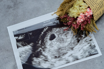 妊娠初期のエコー写真