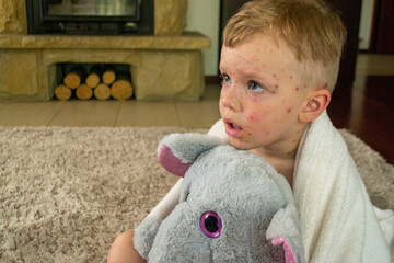 Natural vaccination. Contagious disease. Sick child with chickenpox. Varicella virus or Chickenpox...