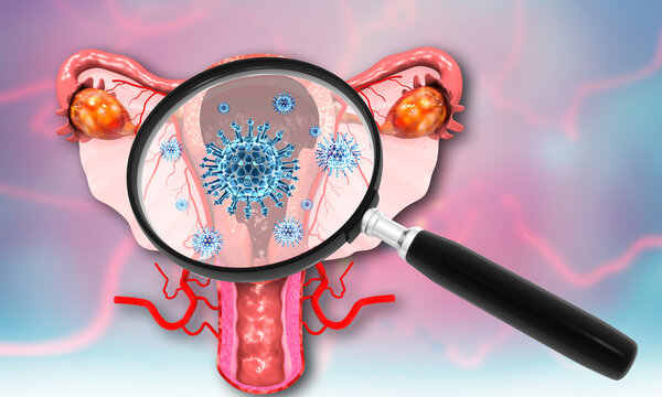 Virus, bacteria infected uterus with magnifying glass. 3d illustration.