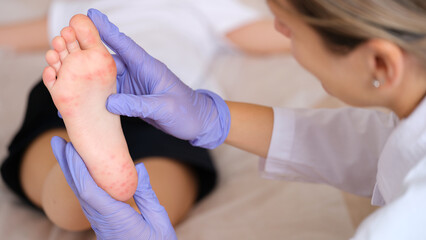 Doctor examining foot of child with red itchy rashes in clinic closeup - obrazy, fototapety, plakaty
