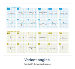 Female, 52 years old, with a history of hypertension for 10 years. Chest pain occurred repeatedly 3 months ago, and ECG confirmed variant angina pectoris.