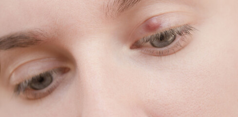  Painful red upper eye lid with onset of stye infection due. Close up of young woman with blue eye...