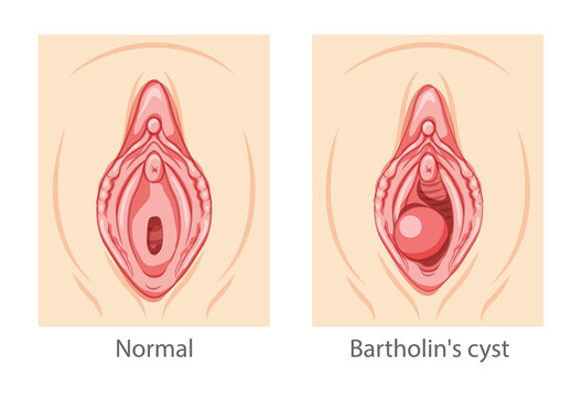 Bartholin's cyst gland Female reproductive system uterus. Female Sick vs normal organs. Human Surface anatomy of perineum external organs location scheme, vagina pain vulva blockage flat style icon