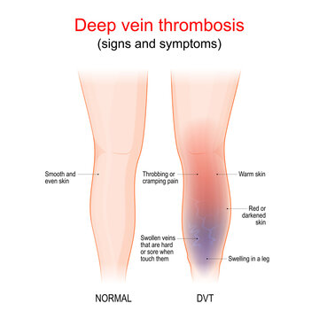 deep vein thrombosis. Healthy leg, and leg with DVT. Sign and symptoms