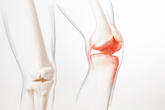 Human leg, knee meniscus, medically accurate representation of an arthritic knee joint