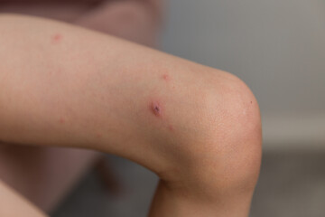 A close-up and detailed view on the knee of a little boy, red pus filled spots are seen around the...