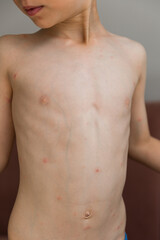 little boy with red spots of chickenpox, close up
