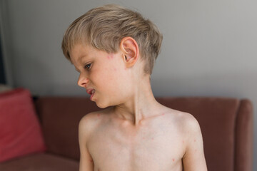 Young toddler with chickenpox. Sick child with chickenpox. Varicella virus or Chickenpox bubble rash on child. Portrait of little boy with pox.