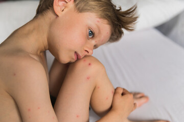 kid boy sitting on chair with chicken pox rash, natural photo