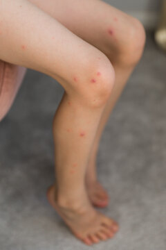 A close-up and detailed view on the knee of a little boy, red pus filled spots are seen around the upper leg, painful and red, symptomatic of chickenpox (varicella zoster virus).