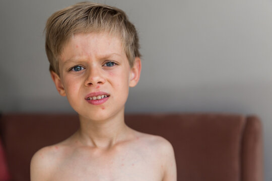 Young toddler with chickenpox. Sick child with chickenpox. Varicella virus or Chickenpox bubble rash on child. Portrait of little boy with pox.