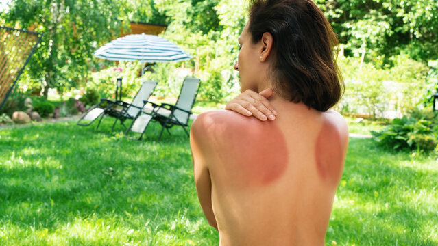 Sunburned skin without uv protection. Girl with sunburn on the background of sun loungers and a beach umbrella. Red marks on the skin of the back from prolonged exposure to the sun.