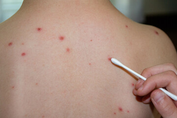 Natural vaccination. Contagious disease. Sick child with chickenpox. Varicella virus or Chickenpox...