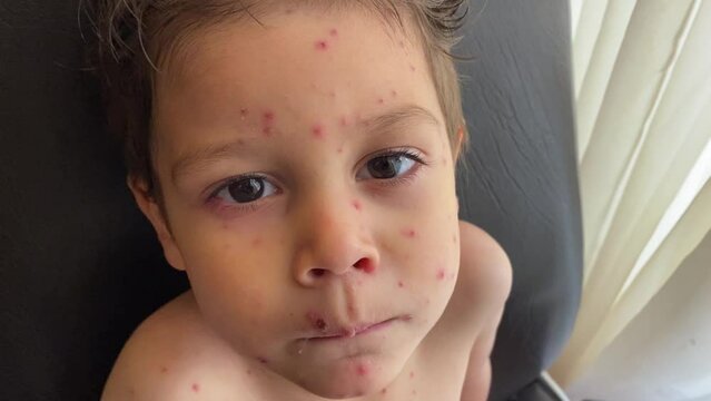 Portrait of child with chickenpox,  varicella zoster virus (VZV). quarantined child