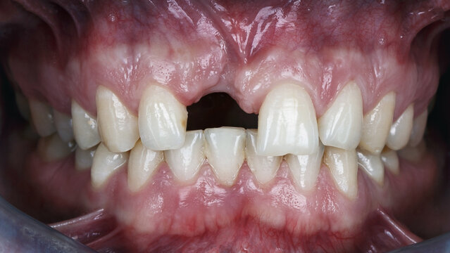 dental ascal without central tooth and lack of bone