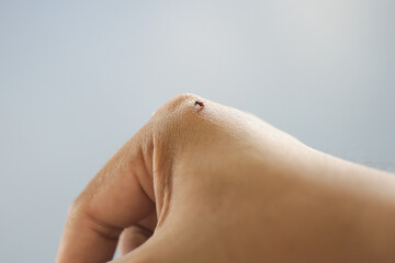 Mosquito bite on hand human skin.