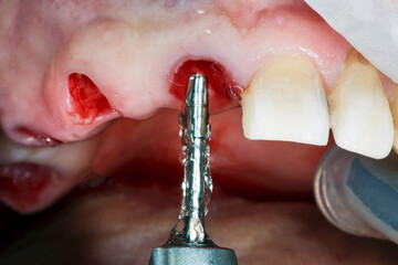 special dental bone cutter for root shield during implantation