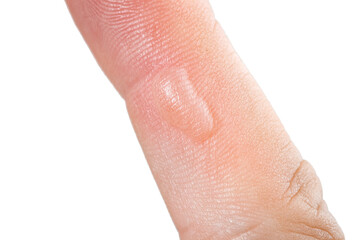 On hand finger there is blister callus or abscess. Medical trauma care concept, close up body with damage human skin isolated on white background.