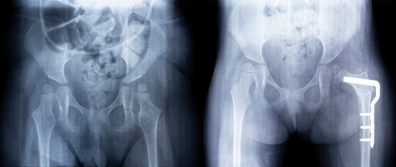X-ray before and after surgery. Femoral osteotomy. X-ray film of the pelvis: dysplasia of the left...