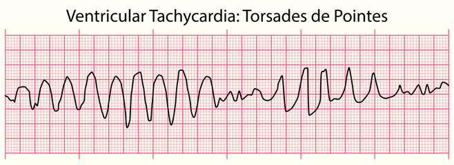 ECG: Ventricular Tachycardia Torsades de Pointes - obrazy, fototapety, plakaty