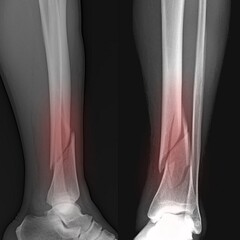 Spiral fracture  of tibia,  x ray image