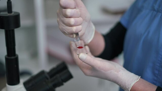 Close-up dripping medical saline solution on glass slide with blood sample for analysis. Unrecognizable laborant preparing specimen for exam under microscope in laboratory in slow motion