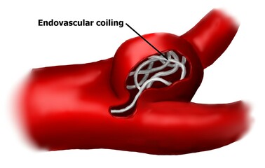 treatment of cerebral aneurysm with endovascular coiling.  - obrazy, fototapety, plakaty