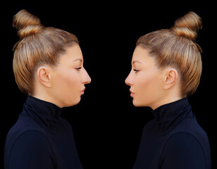 face beauty, nose and chin correction, rhinoplasty, genioplasty,Chin augmentation