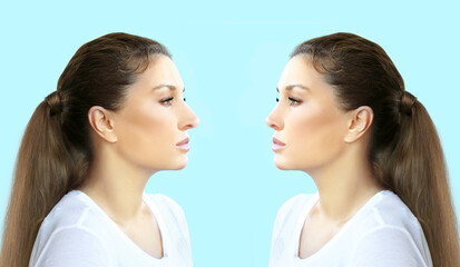 Rhinoplasty,septoplasty. Before and after correction