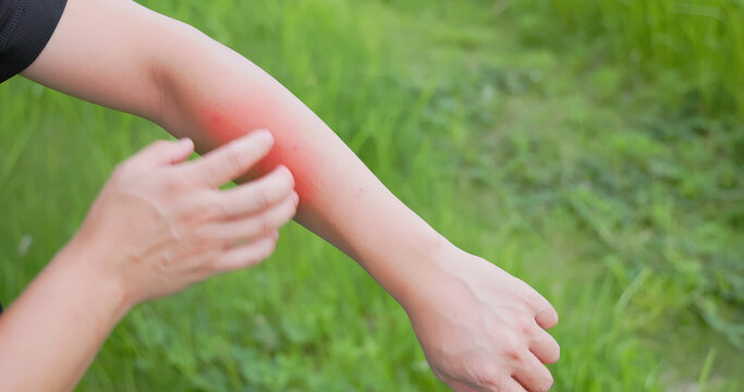 Bitten by mosquito in summer