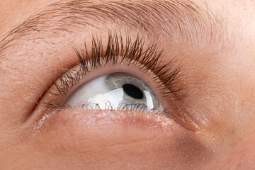 female eye diagnosed with keratoconus corneal thinning.
