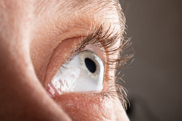 Keratoconus eye closeup , thinning of the cornea.