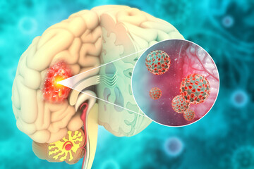 Brain cancer, showing presence of tumor inside brain. 3d illustration - obrazy, fototapety, plakaty