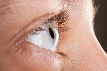 female eye diagnosed with keratoconus corneal thinning. - obrazy, fototapety, plakaty