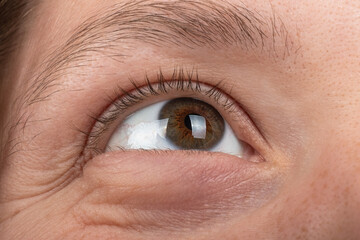 keratoconus disease of the cornea of the eye macro, fatigue corneal thinning.