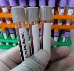 Scientist hold blood sample for Toxicology drug testing, In general, there are four types, close...