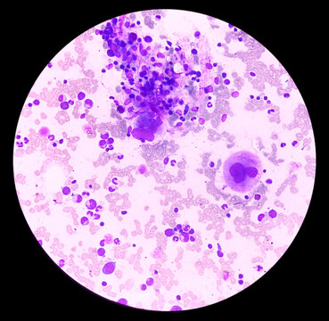 Microscopic view of bone marrow slide, acute myeloid leukemia(AML), type of blood cancer,abnormal myeloblasts.