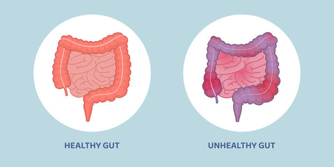 Healthy and unhealthy gut comparison - obrazy, fototapety, plakaty