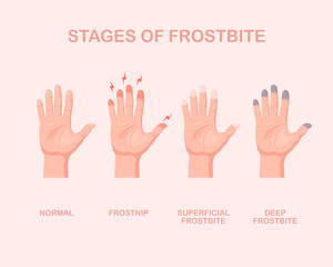 Frozen hands with fingers. Stage of frostbite. Skin burn symptom. Vector illustration isolated.