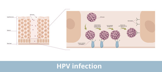 HPV infection. Process of human papillomavirus infection caused by a DNA virus from the Papillomaviridae family with its exposing and cell receptor binding stages.