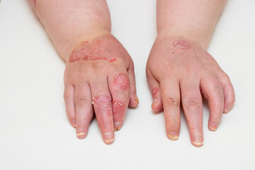 manifestations of psoriasis on the hands of a young woman