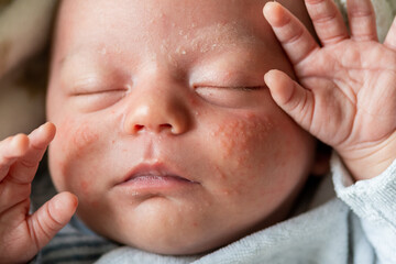 closeup of the face of a newborn baby with pimples on the cheeks due to accumulation of keratin....