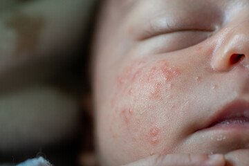 Close-up detail of the cheek of a newborn baby with neonatal acne. skin irritation with small red...
