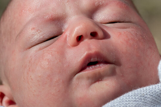 portrait of the face of a newborn baby with red cheeks with small pimples, childhood acne, fattening, milia. injury to the baby's face in the first few months. atopic dermatitis. newborn baby face and