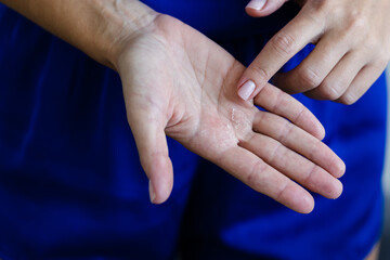 Woman shows problem with dry skin on the hand. Closeup. Selective focus. 