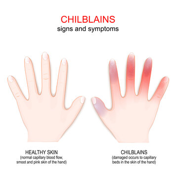 chilblains. human hand with symptoms of pernio.