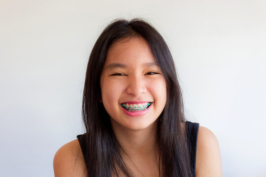 portrait of asian woman face with colorful braces and smile happily