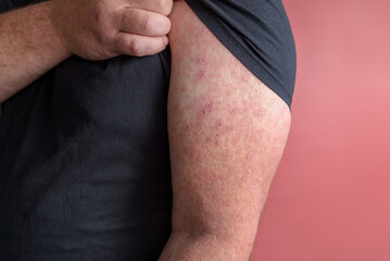 Erysipelas Red rash appears on the forearm. Close up