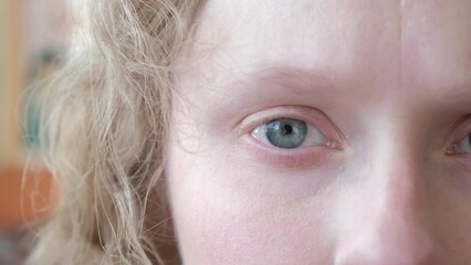 woman with nystagmus, uncontrolled rhythmic movements of the eyeballs, Pathological nystagmus